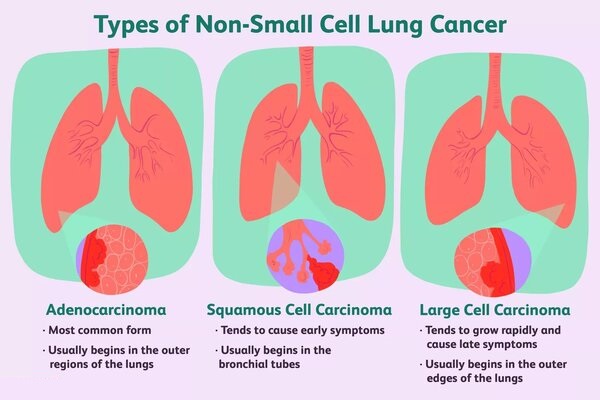 Non Small cell lung carcinoma Non Small cell lung carcinoma treatment in india, lung cancer survival rate in india