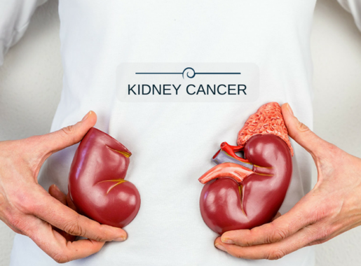 kidney cancer treatment after surgery,kidney cancer treatment in india