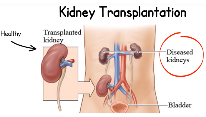 kidney transplantation in india