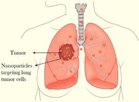 lung tumor, stage 4 lung cancer treatment in india, best lung cancer treatment in india
