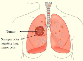 lung tumor lung tumor, stage 4 lung cancer treatment in india, best lung cancer treatment in india