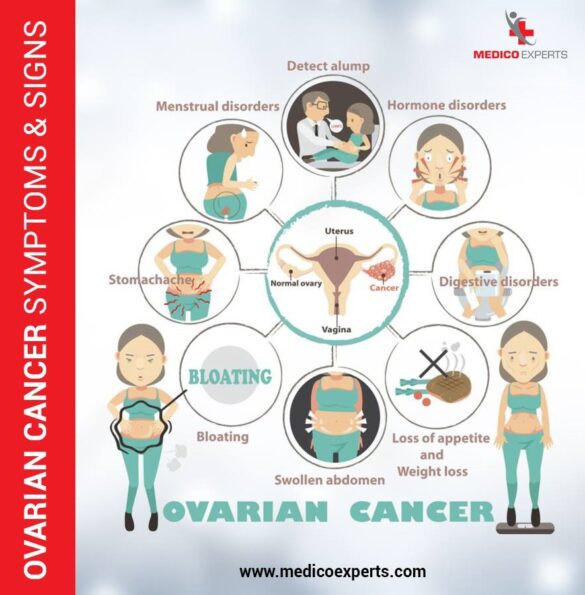 sign and symptoms of ovarian cancer, ovarian cancer treatment in india