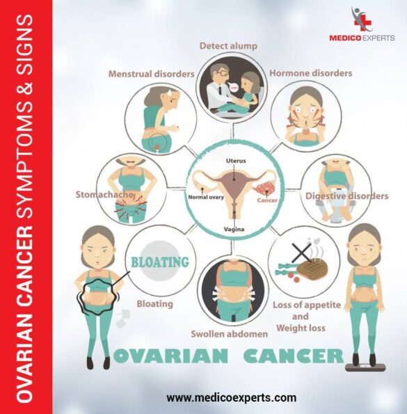sign and symptoms of ovarian cancer sign and symptoms of ovarian cancer, ovarian cancer treatment in india