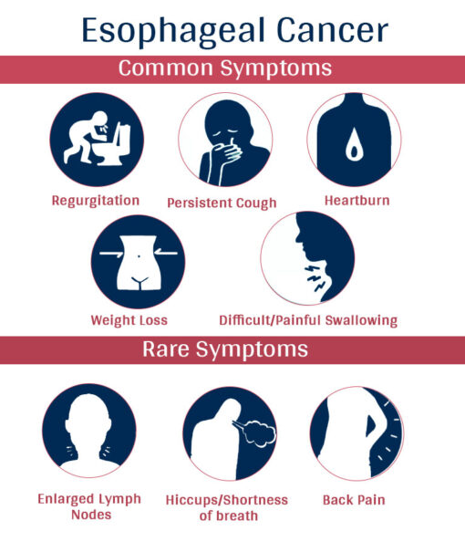 signs and symptoms-Esophageal-Cancer, esophagus cancer signs, esophageal tumors symptoms, esophageal cancer treatment centers