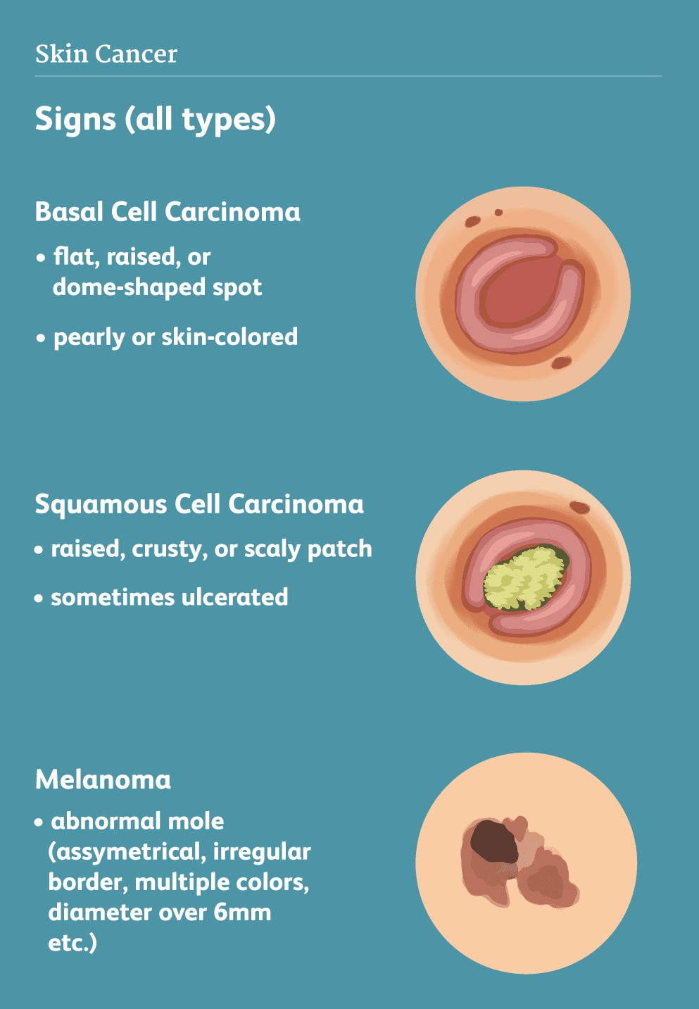 skin cancer symptom, skin cancer treatment cost in india