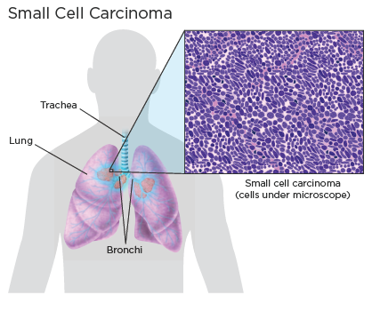 small-cell-lung cancer small-cell-lung cancer treatment in india, best lung specialist in india, lung cancer treatment in india
