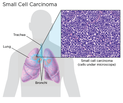 small-cell-lung cancer treatment in india, best lung specialist in india, lung cancer treatment in india