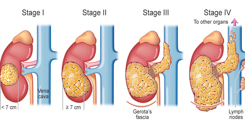 stages of Kidney-cancer