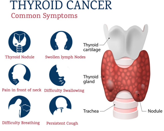 thyroid cancer symptoms, best thyroid treatment in india