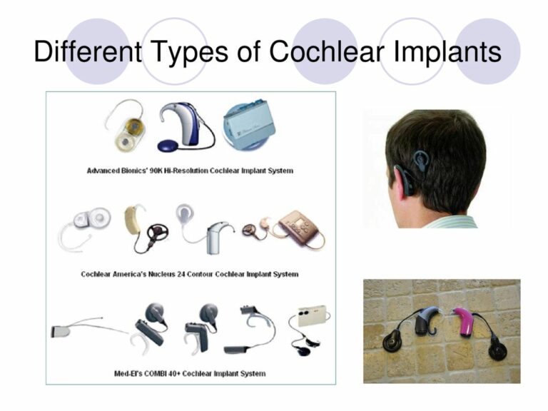 Cochlear Implant Surgery: Treatment For Hearing Loss