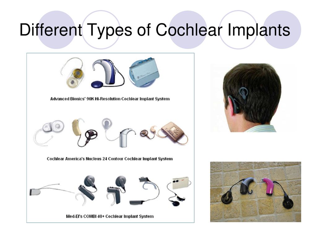 cochlear implant types