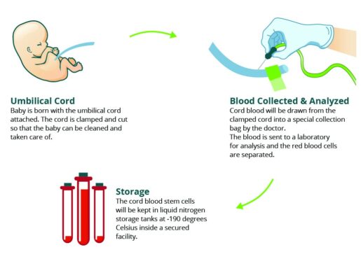 umbilical cord blood transplant