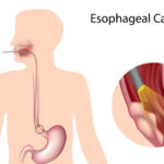 what is esophageal cancer