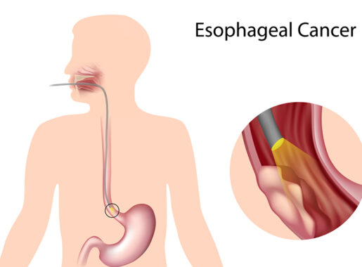 what is esophageal cancer, esophagus cancer treatment, esophageal cancer treatment in india