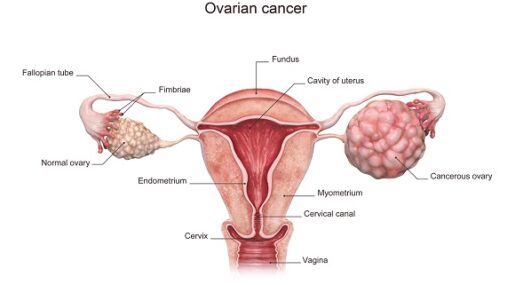what is ovarian cancer, ovarian cancer treatment in india