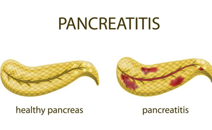 what is pancreas transplant