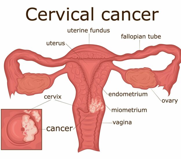 cervical cancer treatment in india, best doctor for cervical cancer