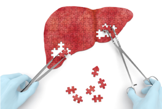 liver cancer surgery in india, best hospital for liver cancer treatment in india