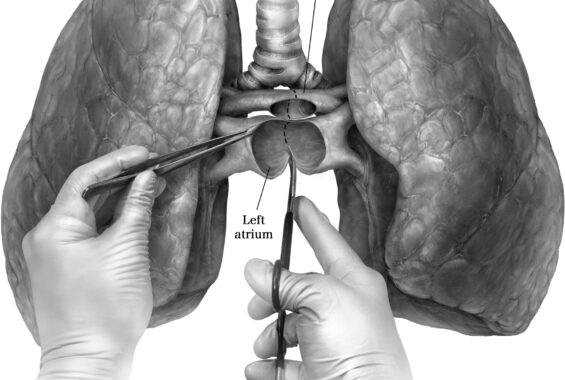 lung transplant in india, lung transplant procedure