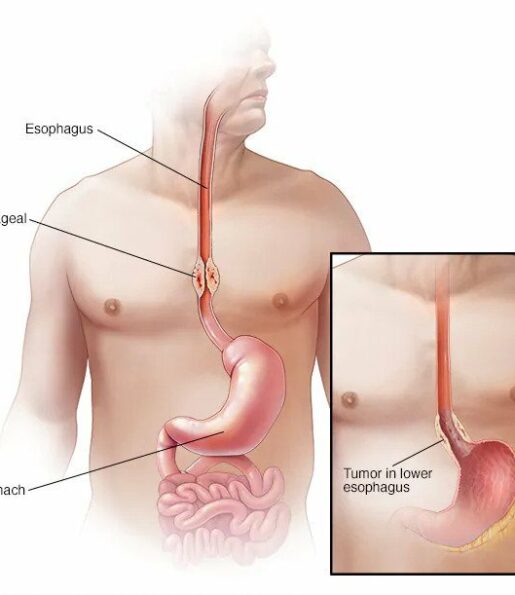 Esophagus cancer treatment in india, esophageal cancer treatment in india