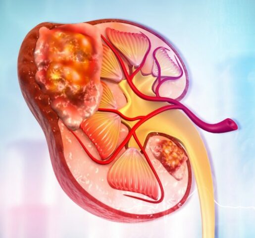 kidney cancer treatment in india, kidney tumor surgery in india