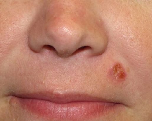 best skin cancer treatment in india best skin cancer treatment in india, squamous cell carcinoma treatment in india