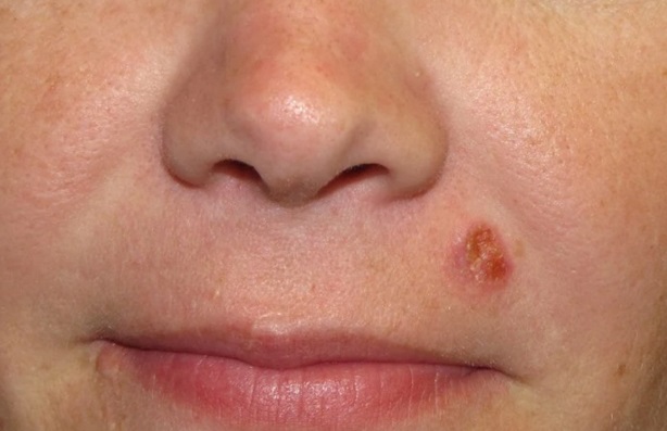 best skin cancer treatment in india best skin cancer treatment in india, squamous cell carcinoma treatment in india
