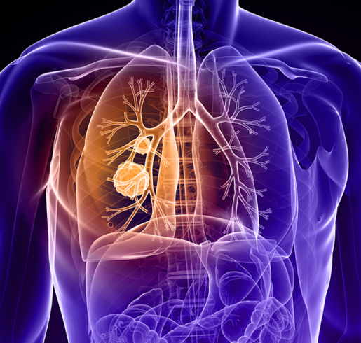 best lung cancer treatment in india, lung cancer treatment cost in india