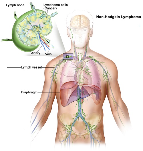 non hodgkin's lymphoma, non hodgkin's lymphoma treatment in india