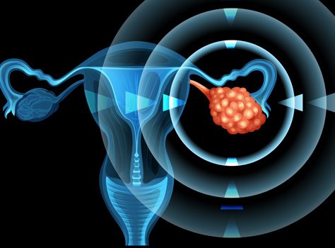 ovarian cancer treatment in india, ovarian cancer treatment stage 4