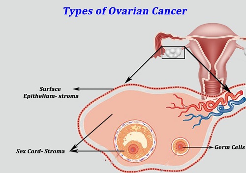 types of ovarian cancer, ovarian cancer treatment cost in india, ovarian cancer treatment stage 4