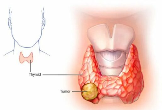 what is thyroid cancer, best thyroid treatment in india, best thyroid cancer hospital in india
