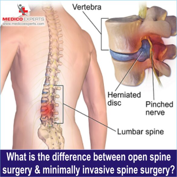 Minimally Invasive Spine Surgery in India, minimally invasive spine surgery