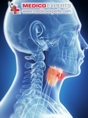 laryngeal cancer treatment in India, laryngeal cancer treatment