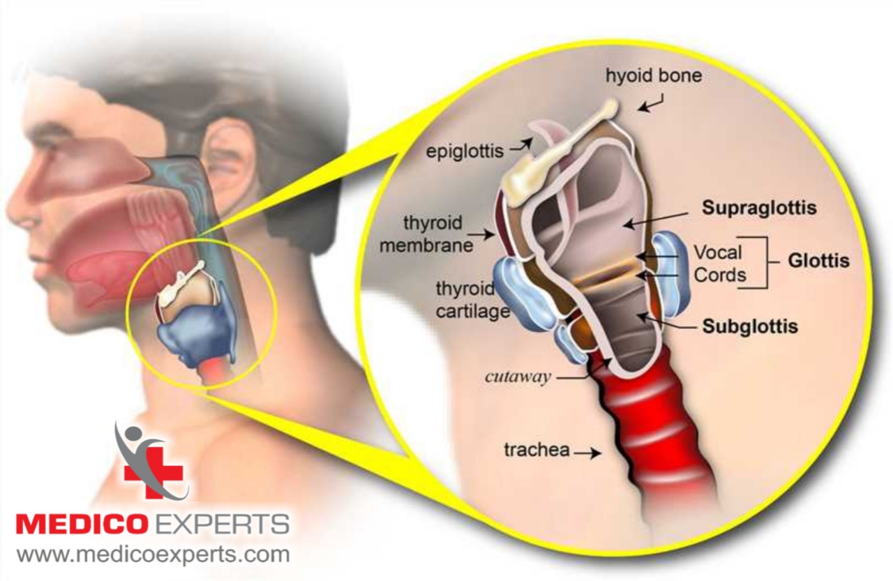 What is laryngeal cancer, best throat cancer doctor in india