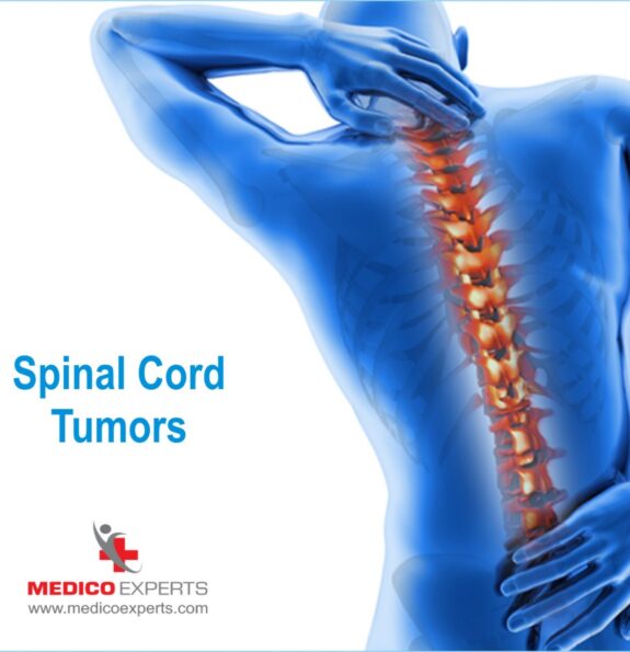 spine tumor surgery in india, spinal cord tumor treatment in india