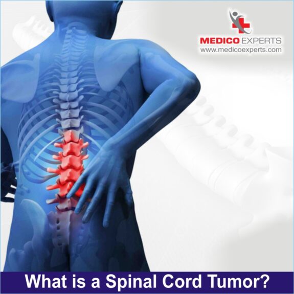 spinal cord tumor, spinal cord tumor treatment in india