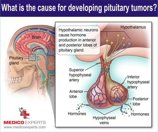 cause of developing pituitary tumor