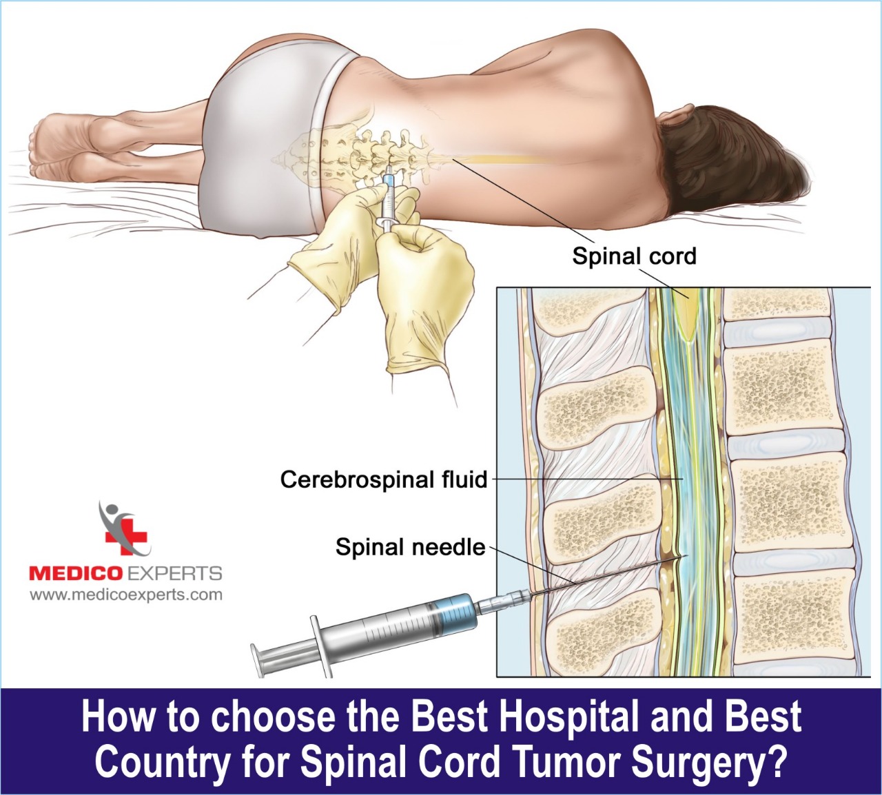 choose best hospital and surgeon for spine tumor