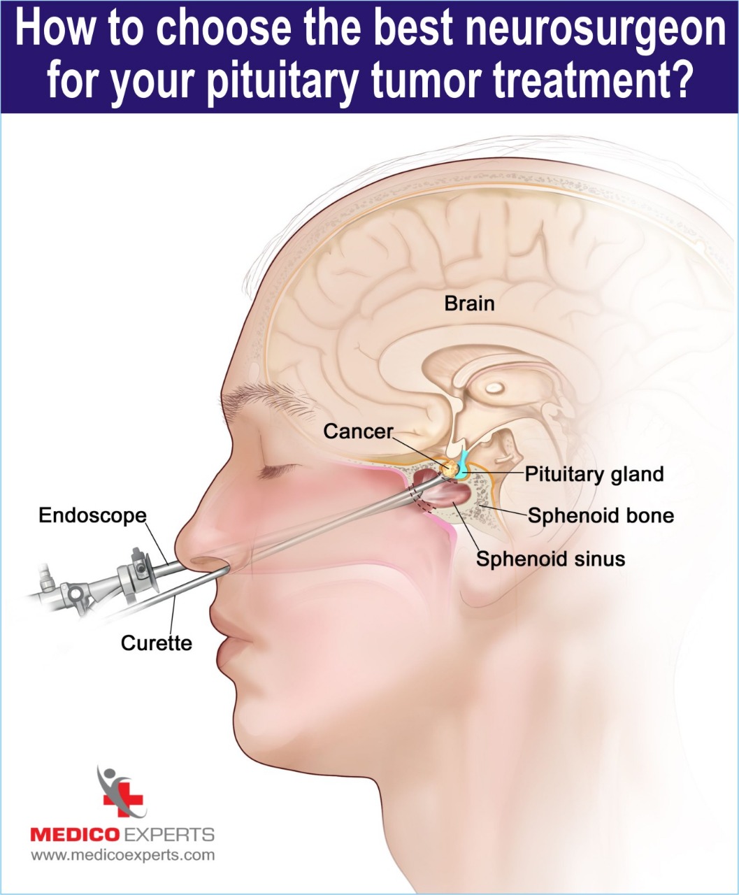 choose best neurosurgeron for pituitary tumor treatment