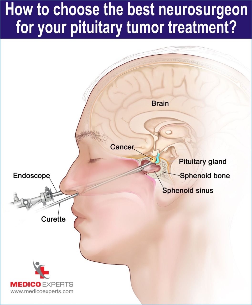 choose best neurosurgeron for pituitary tumor treatment choose best neurosurgeron for pituitary tumor treatment