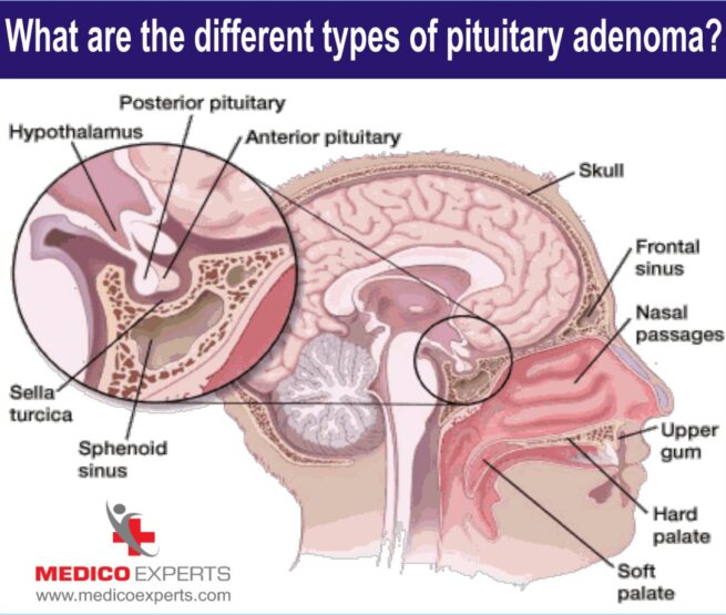 different types of pituitary tumor
