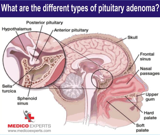 different types of pituitary tumor different types of pituitary tumor