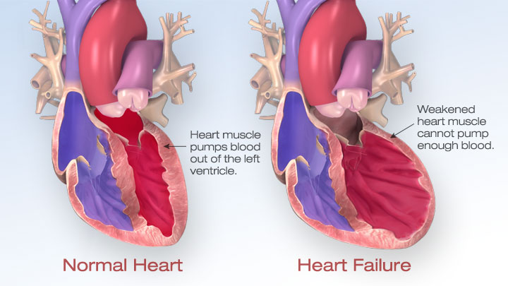 heart failure, heart failure treatment in india, heart transplant surgery in india