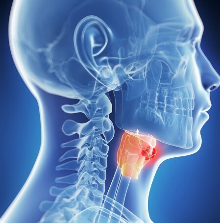 larynx_cancer-treatment in india, laryngeal cancer treatment in india