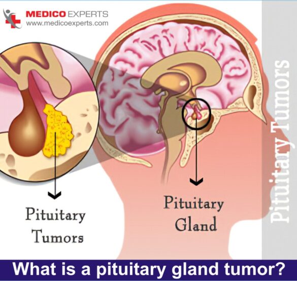 pituitary gland tumor pituitary gland tumor