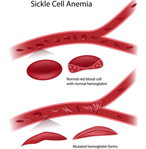 Sickle cell anemia treatment in India