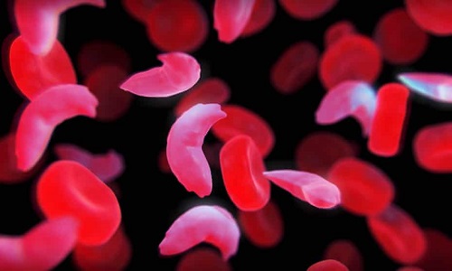 Sickle cell anemia treatment in India