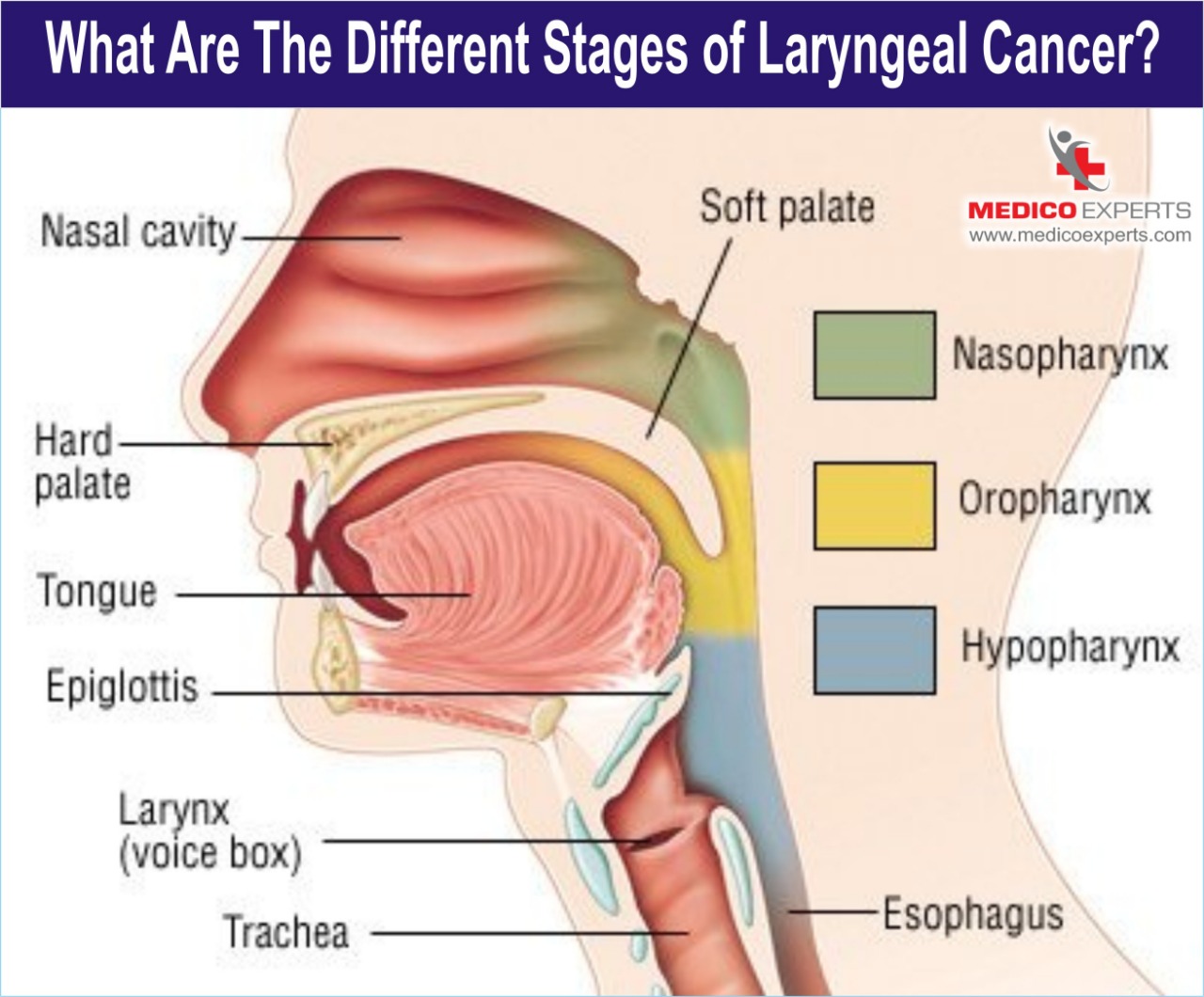 stages of laryngeal cancer, laryngeal cancer treatment