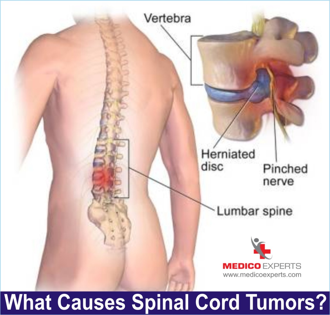 what causes spinal cord tumors